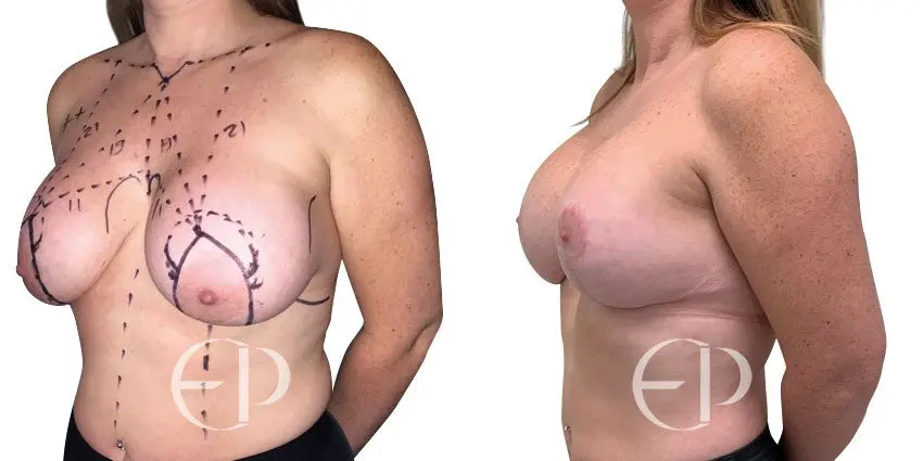 Woman underwent Mummy Makeover surgery to fix lower belly pooch, excess tummy fat, skin and drooping breasts. 