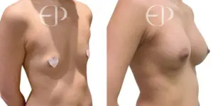 Breast Augmentation