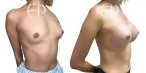 Breast Augmentation