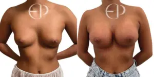 Breast Augmentation