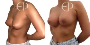 Breast Augmentation