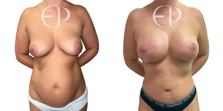 The woman on the left has deflated breasts, excess skin, and tummy fat; the correction on the right shows a flat, firm stomach and full, round breasts.  