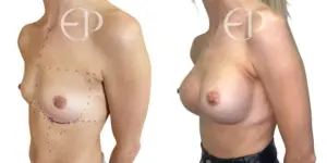 Breast Augmentation