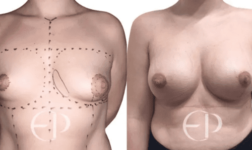 Tuberous Breast Correction Surgery