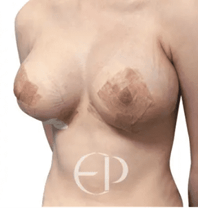 woman after breast surgery