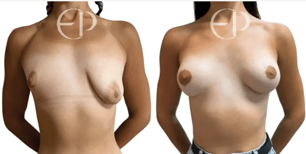 woman with severe breast asymmetry and tuberous breast deformity (left) and her correction and augmentation (right)