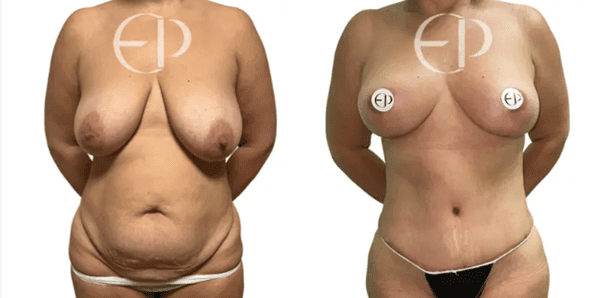 The woman on the left has oversized, sagging breasts with mild asymmetry. She also has excess skin and tummy fat. On the right is her post-surgery body with a tight, flat stomach and perky, symmetrical breasts. 