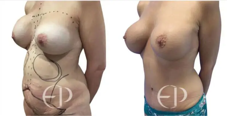 The woman on the left has excess skin and tummy fat and asymmetrical breast implants from a previous procedure. Elena Prousskaia replaces the old breast implants to correct shape, symmetry and size. The patient also now has a flat and firm abdomen.  