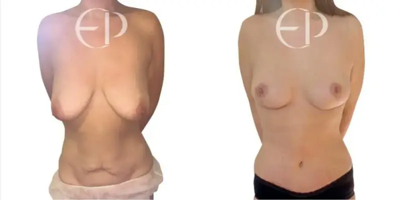 The woman on the left has sagging breasts and excess skin on her stomach. The patient undergoes a breast lift, breast reduction and tummy tuck to achieve a toned and youthful figure. 