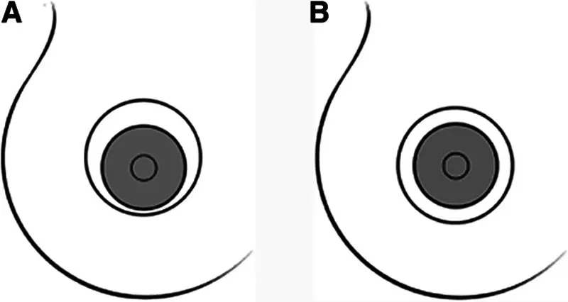 Round-block (periareolar), Nipple scar location