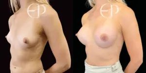breast augmentation before and after