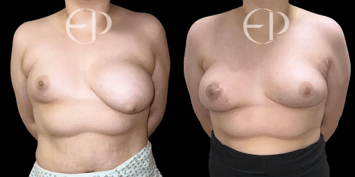 Patient before-and-after results illustrating treatment of tuberous breasts