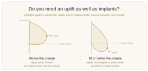 breast-uplift-nipple-position