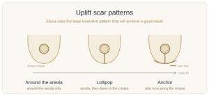 breast-uplift-scar-patterns