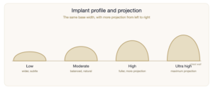 implant profile and projection