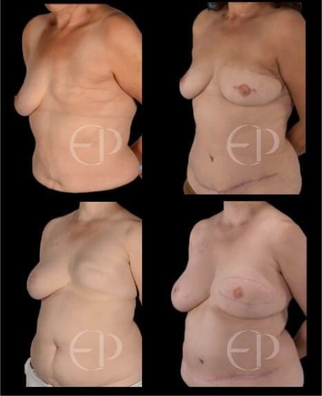 Current issues in breast reconstruction