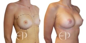 Before and after breast augmentation surgery
