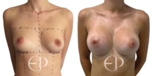 before and after Breast Augmentation