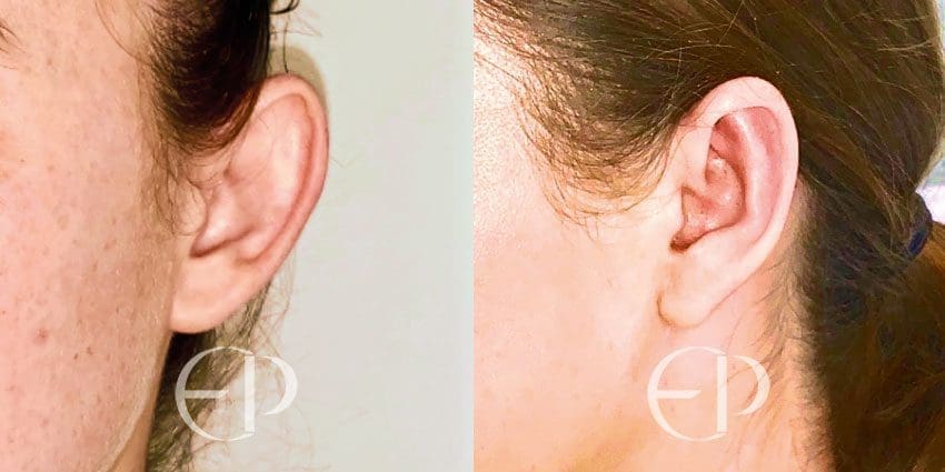 otoplasty in London