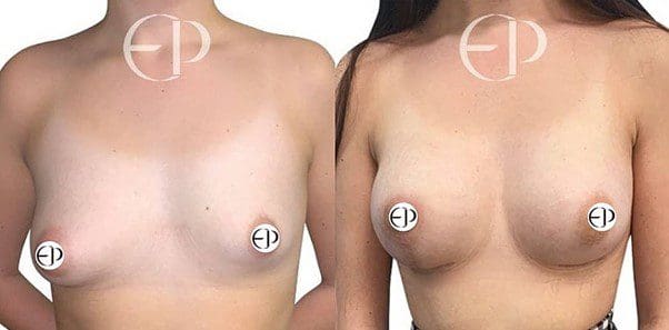 On the left is a woman displaying tubular breast deformities. On the right, the same woman, after plastic surgery, has full, round breasts with a more natural teardrop shape. The areolas/nipples are no longer prolapsed nor downward pointing. There is minimal scarring around the areolas and on the underside of the right breast.