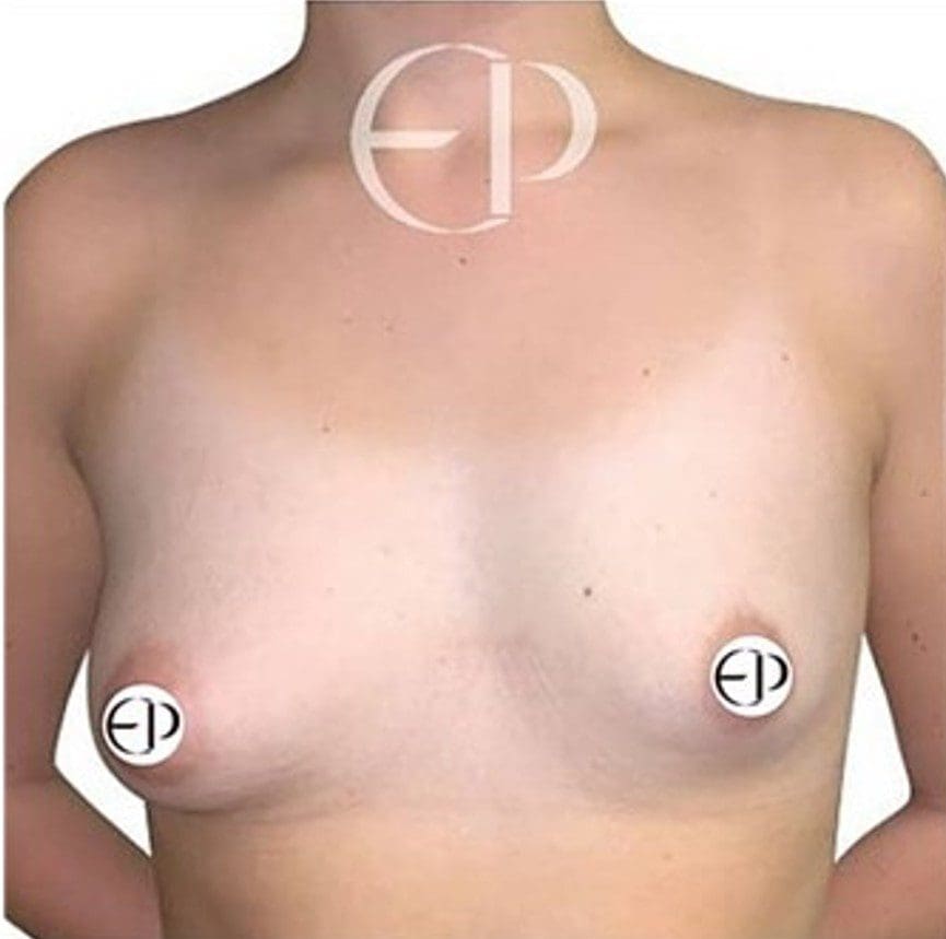 A woman with type II (moderate) tubular breasts. There is breast asymmetry, nipple/areola prolapse, downward pointing of the nipples and underdevelopment in the lower portion of the breasts.