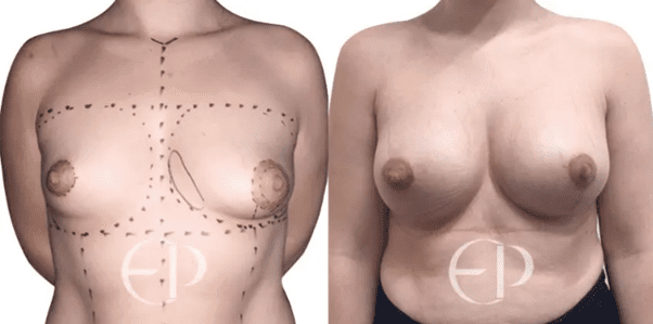 on the left is a patient with small, asymmetric tubular breasts (type II) with a large, prolapsed areola on the right. On the right, the same woman has had a correction; the breasts are full but natural-looking and symmetrical. Both nipples are a normal size. 
