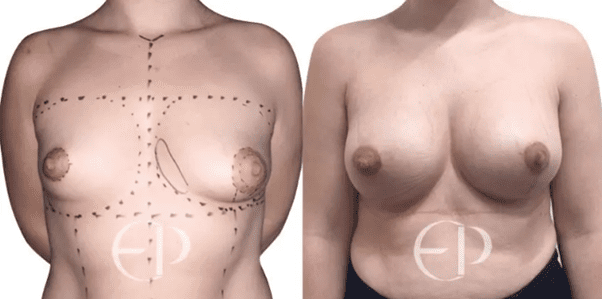 Best Large Breasts Treatment London