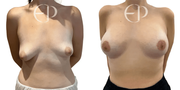 One of Elena Prousskaia’s tuberous breast patients with type III, moderately asymmetrical breasts on the left. On the right is her correction; the breasts are full but natural-looking and symmetrical with no sign of deformity. 