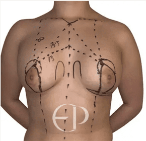 Two women with type 0 tuberous breasts. They have relatively normal-looking breasts but with areolar herniation