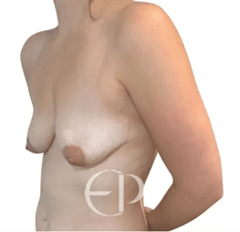 Here, we have two women with type III tuberous breasts. The breasts are oval or conic and drooping. The right also shows an elevated inframammary fold