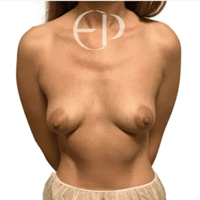 Here, we have two women with type IV tuberous breasts; there are small breast bases with peripheral breast restriction.