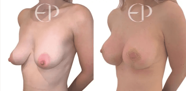 woman with type 0 tuberous breasts (left) and her correction and augmentation (right)