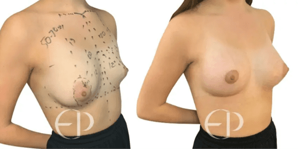 A woman with type II tuberous breasts (left) and her correction and breast augmentation (right)