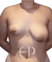 women with three different grades of breast asymmetry. The left is the mildest asymmetry, and the right is the most severe asymmetry.