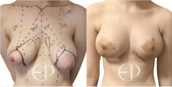 The left shows severe type III tuberous breasts with significant drooping. The right shows the correction with good breast volume, shape, symmetry and a lower inframammary fold. 