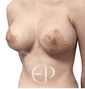 Woman after breast surgery