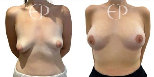 What to expect from tuberous breast surgery? Everything you need to know about eligibility, recovery and results