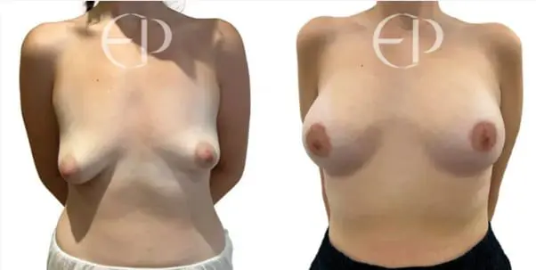 A woman with type III tuberous breasts (left) and her correction and breast augmentation (right)