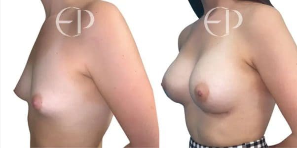 Woman with type I tuberous breasts (left) and tuberous breast correction and breast augmentation (right)