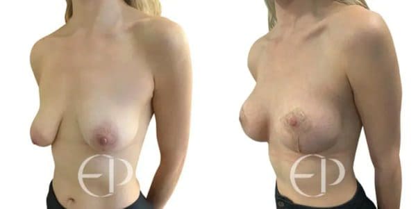 Woman with type IV tuberous breasts (left) and tubular breast correction and augmentation (right)
