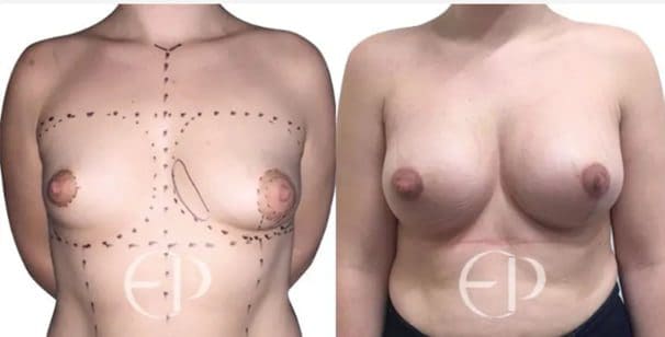 A patient has undergone tuberous breast surgery; on the right is her healed breast augmentation, the scars have healed, and the breasts have a natural shape. 
