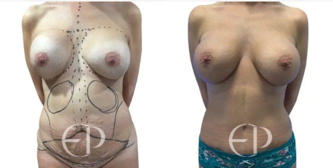On the left is a woman with large symmetrical breasts but she wanted a Mummy Makeover to correct some excess tummy skin & fat, mild breast drooping and lack of volume. On the right are the results: wonderfully full, perky and symmetrical breasts and a flat, toned stomach