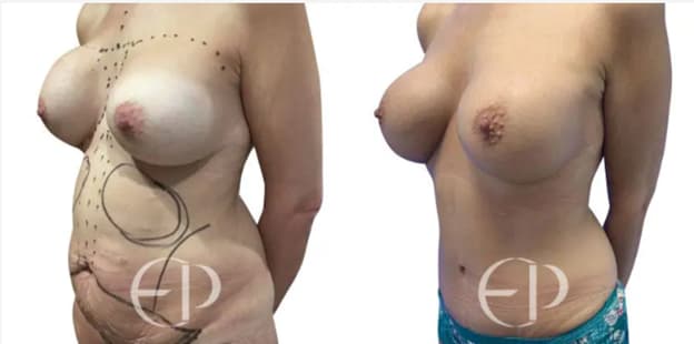 A patient’s full-body transformation. Elena corrects abnormal breast shape from previous breast implants, tummy overhang, excess fat, skin and bulging abdomen.