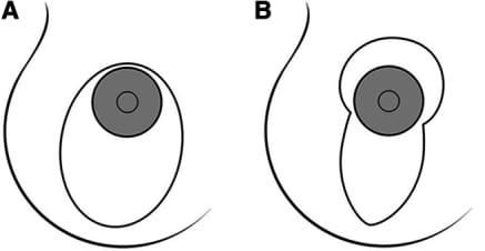 Vertical scar breast lift, Nipple scar location