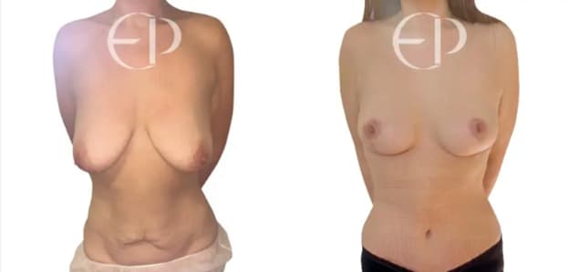 Before and after surgery