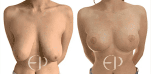 image of breast lift before and after