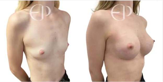 Full & Teardrop implants
