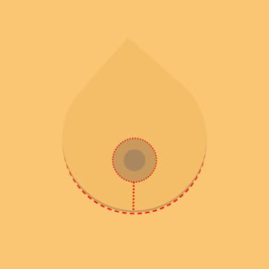 breast lift scar diagram